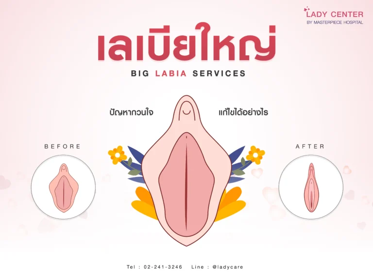 เลเบียใหญ่เกิดจากอะไร ปัญหากวนใจ แก้ไขได้อย่างไร?